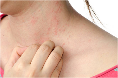 skin rashes